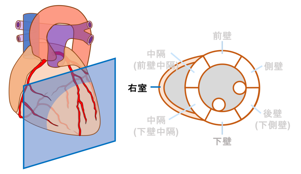 右室梗塞(right ventricular infarction)