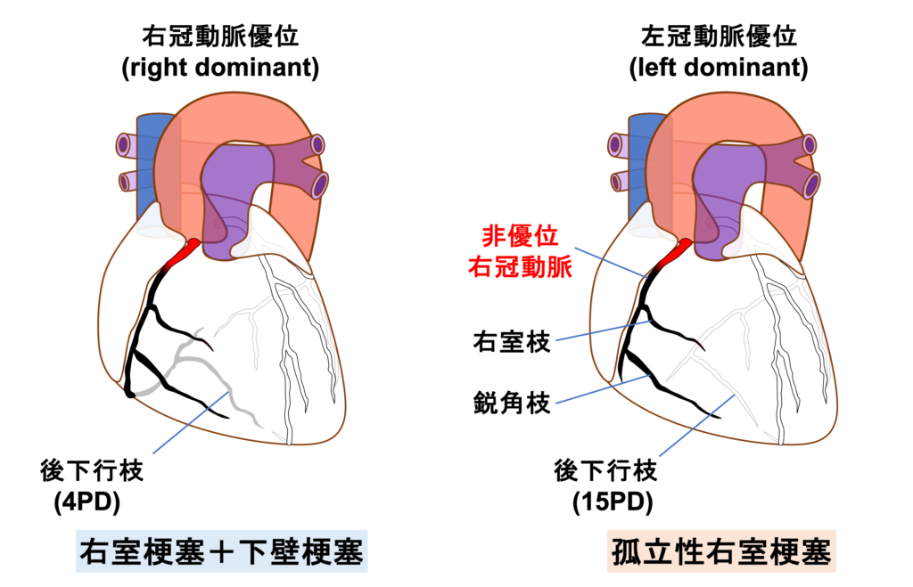 孤立性右室梗塞(isolated right ventricular infarction)