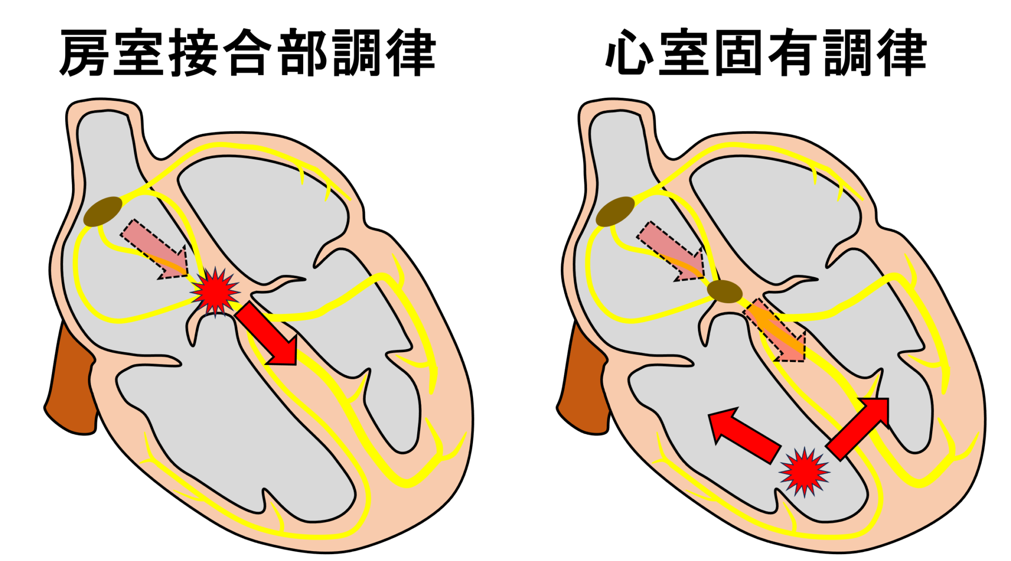 心室固有調律とは? | 心電図.com