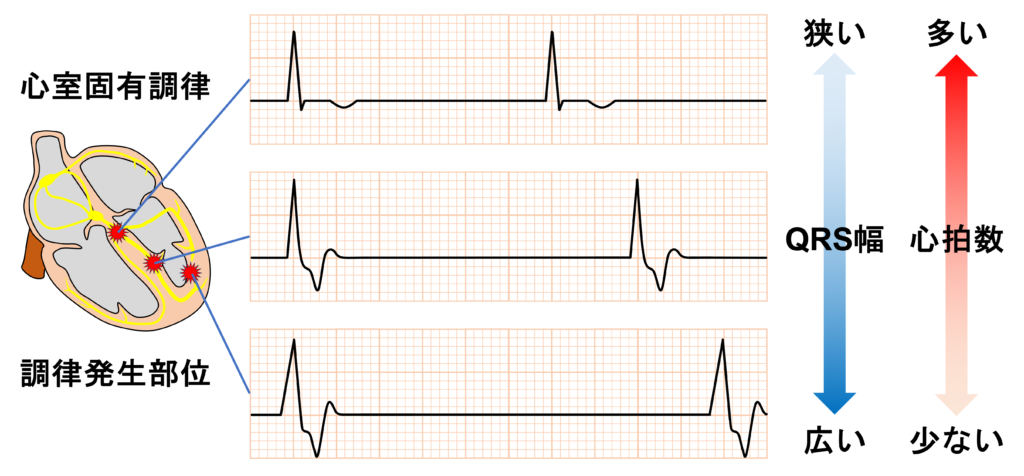 心室固有調律(idioventricular rhythm)