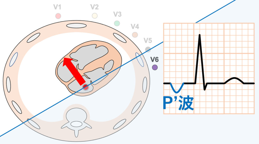 左房調律(left atrial rhythm)