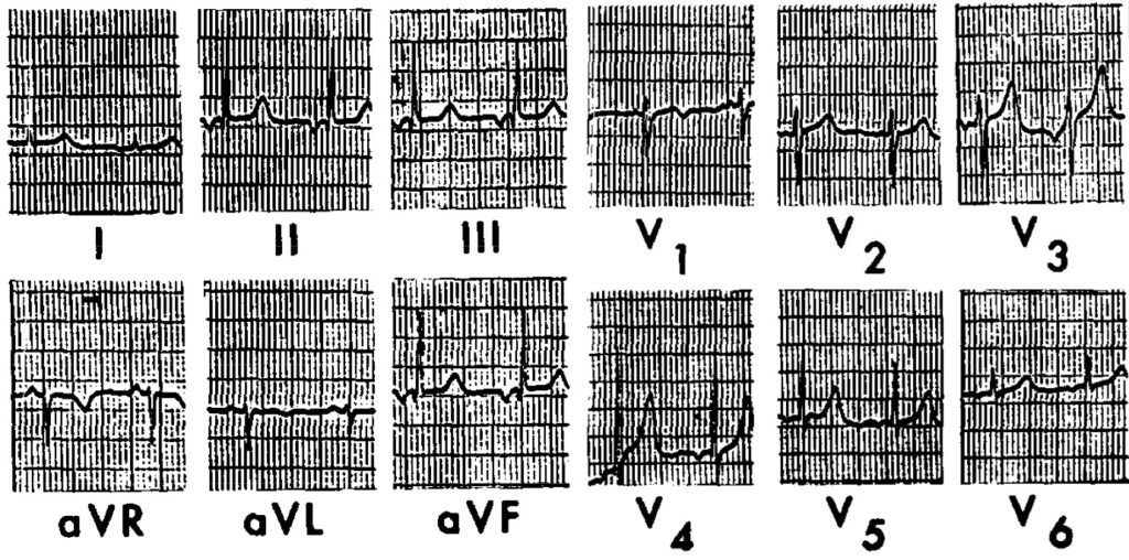 左房調律(left atrial rhythm)