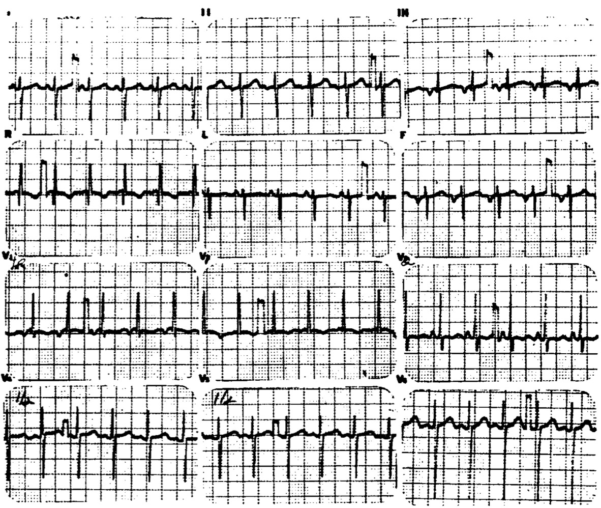 冠静脈洞調律(coronary sinus rhythm)