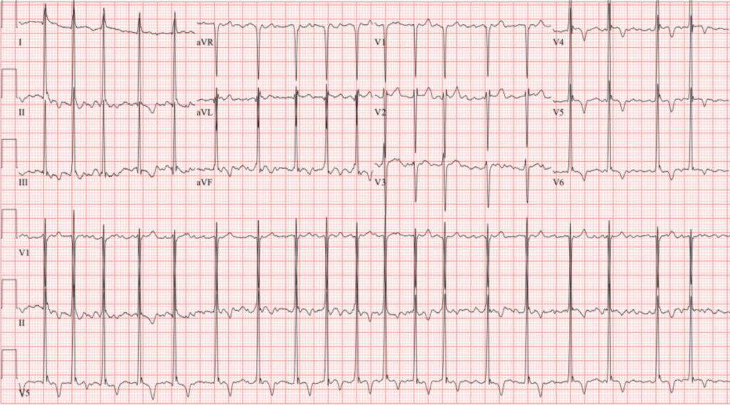 心房細動(Atrial fibrillation)