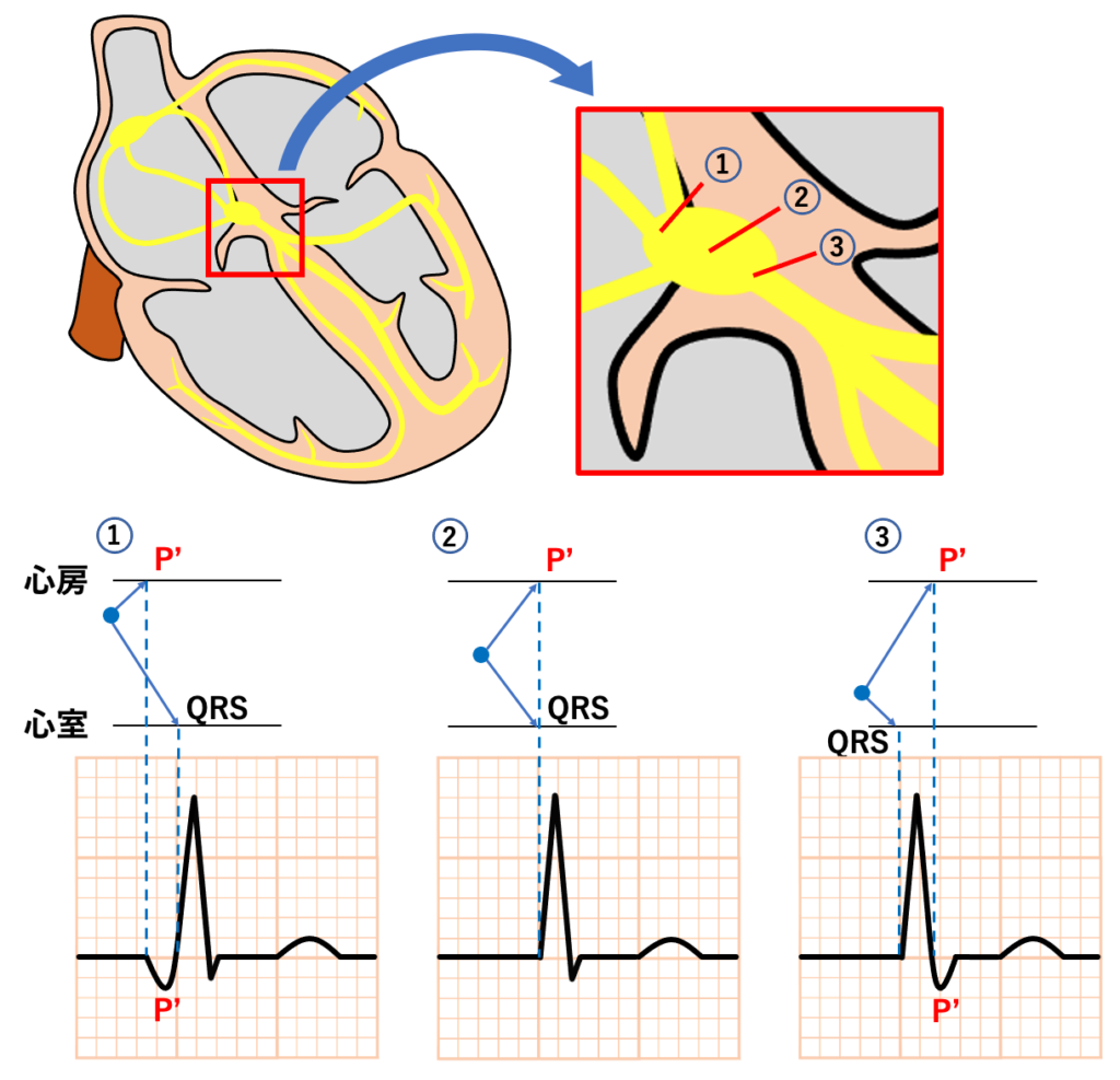 房室接合部調律(Junctional rhythm)