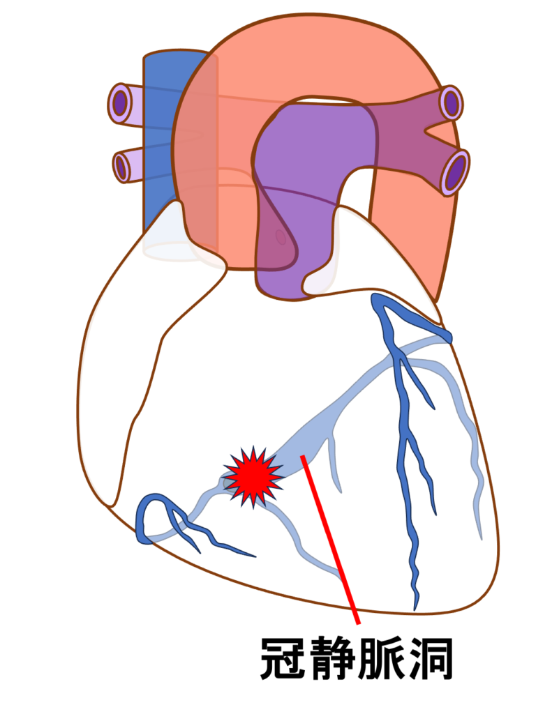 冠静脈洞調律(coronary sinus rhythm)