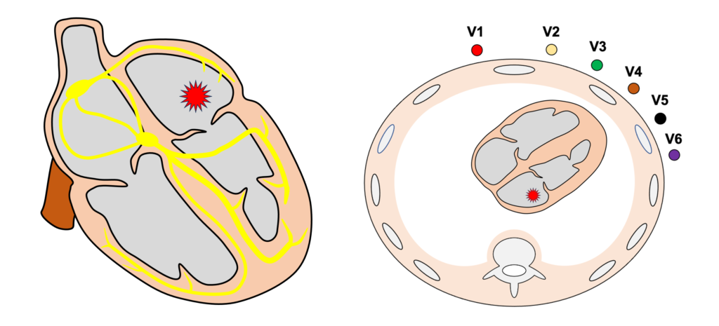 左房調律(left atrial rhythm)