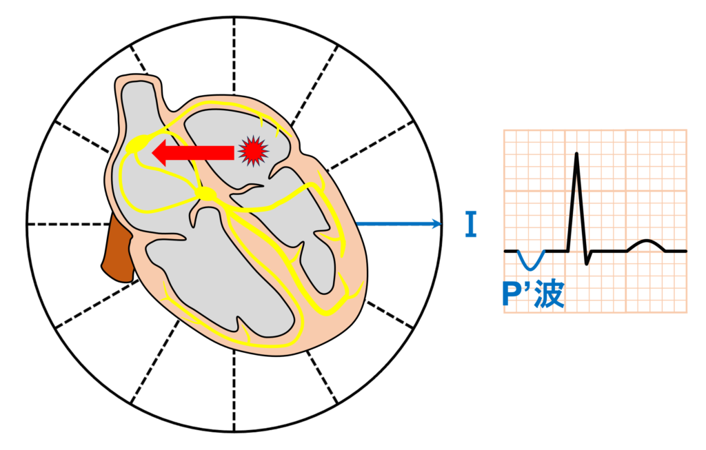 左房調律(left atrial rhythm)