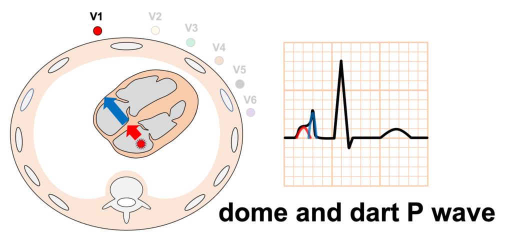 左房調律(left atrial rhythm)