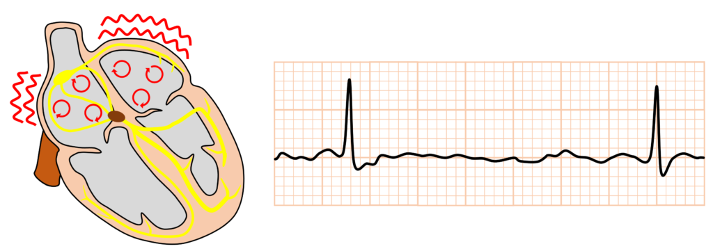 徐脈性心房細動(bradycardiac atrial fibrillation)