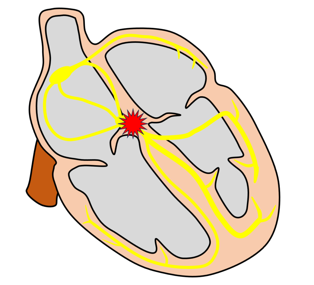 房室接合部調律(Junctional rhythm)