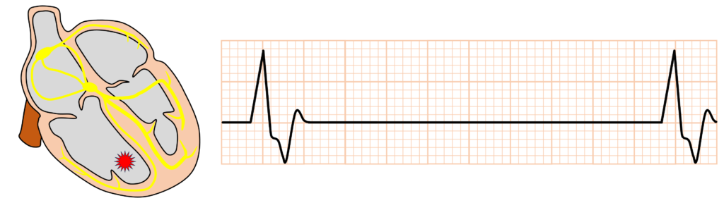 心室固有調律(idioventricular rhythm)