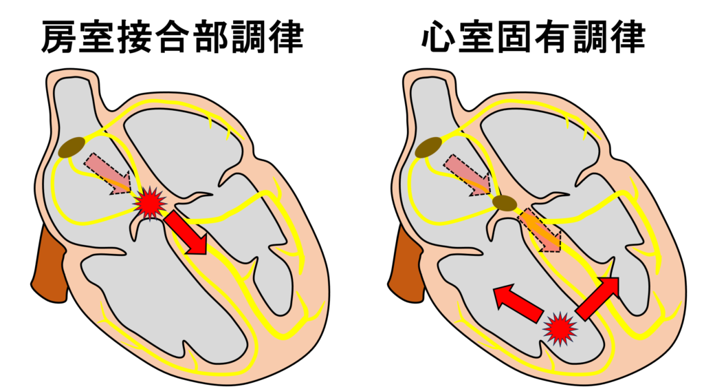 心室固有調律(idioventricular rhythm)