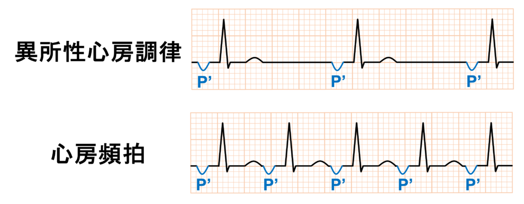 異所性心房調律(Ectopic atrial rhythm：EAR)