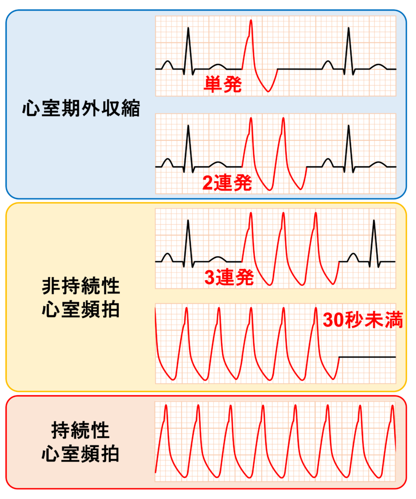 非持続性心室頻拍(Non-sustained ventricular tachycardia: NSVT)