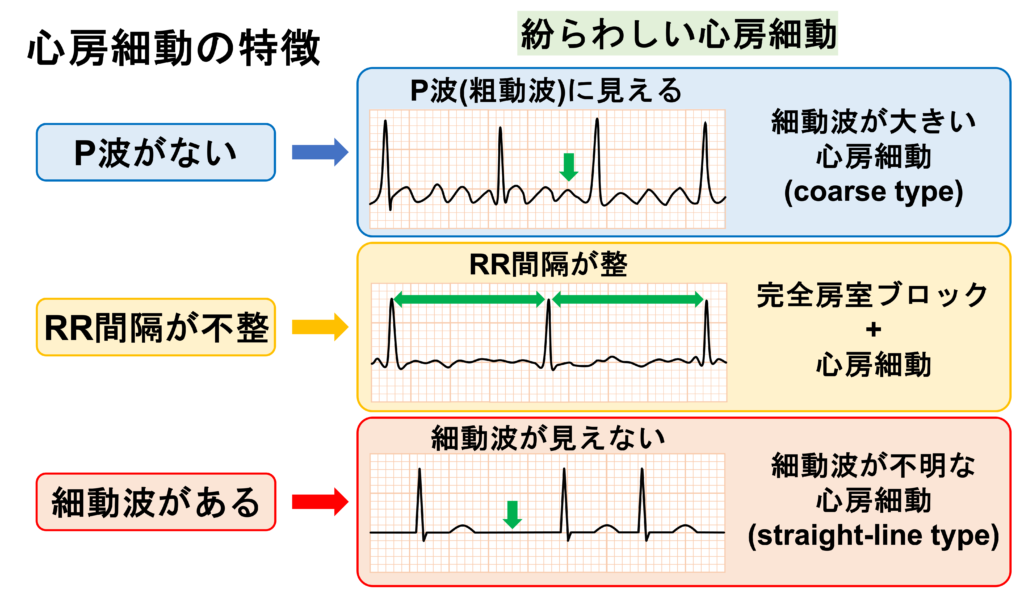 心房細動(Atrial fibrillation)