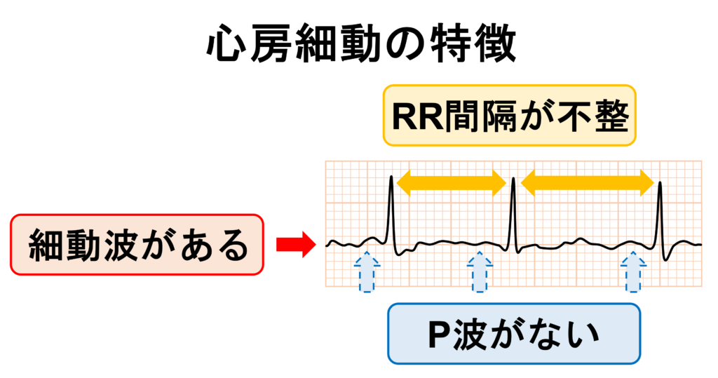 心房細動(Atrial fibrillation)