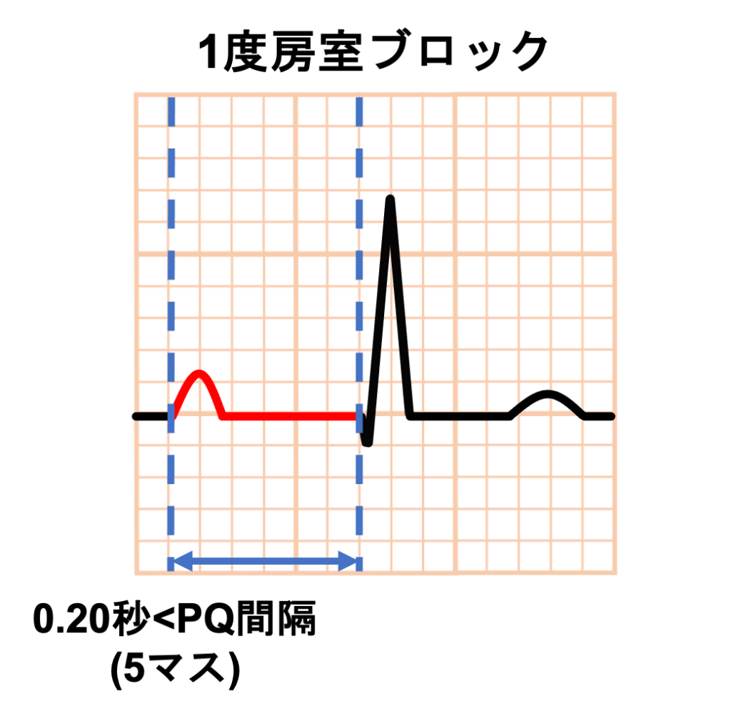 1度房室ブロック(First degree atrioventricular block)