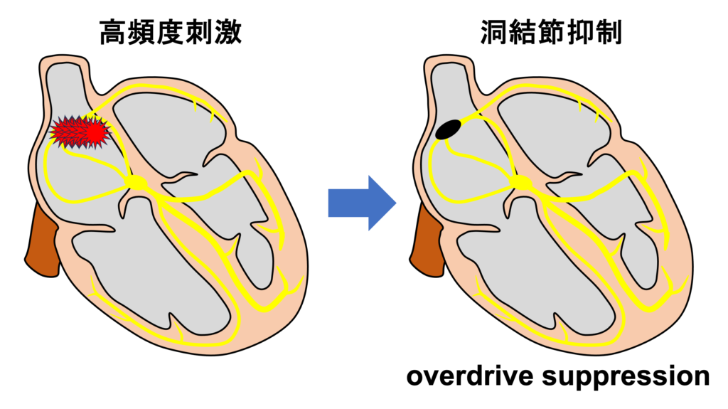 徐脈頻脈症候群(tachycardia-bradycardia syndrome)