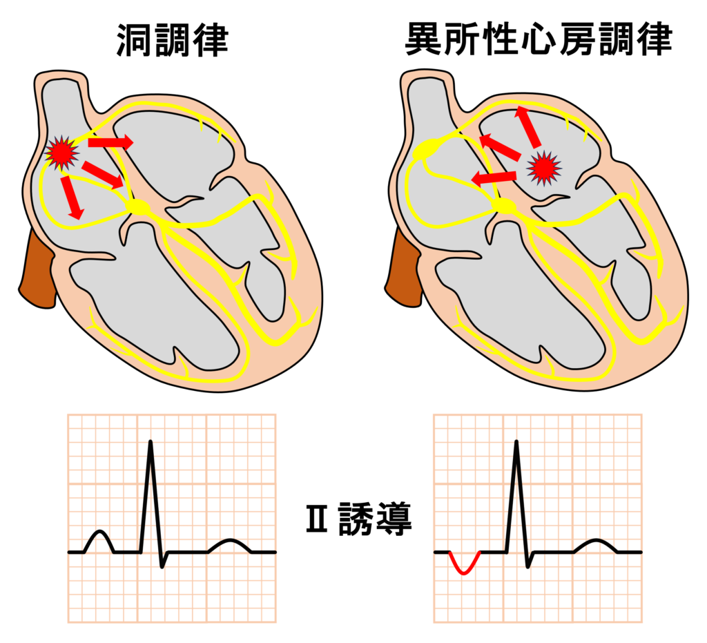 異所性心房調律(Ectopic atrial rhythm：EAR)