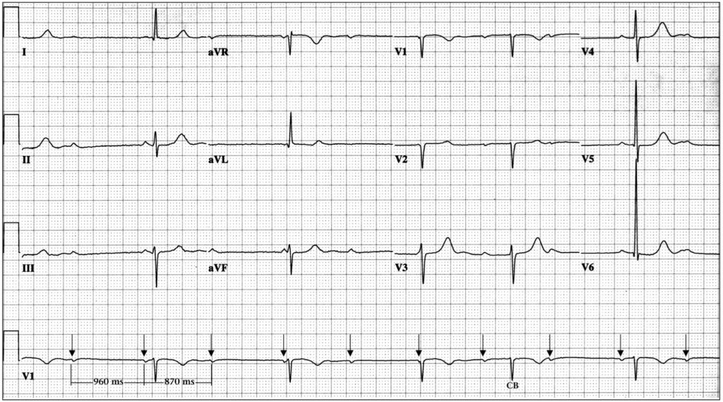 心室相性洞不整脈(ventriculophasic sinus arrhythmia)