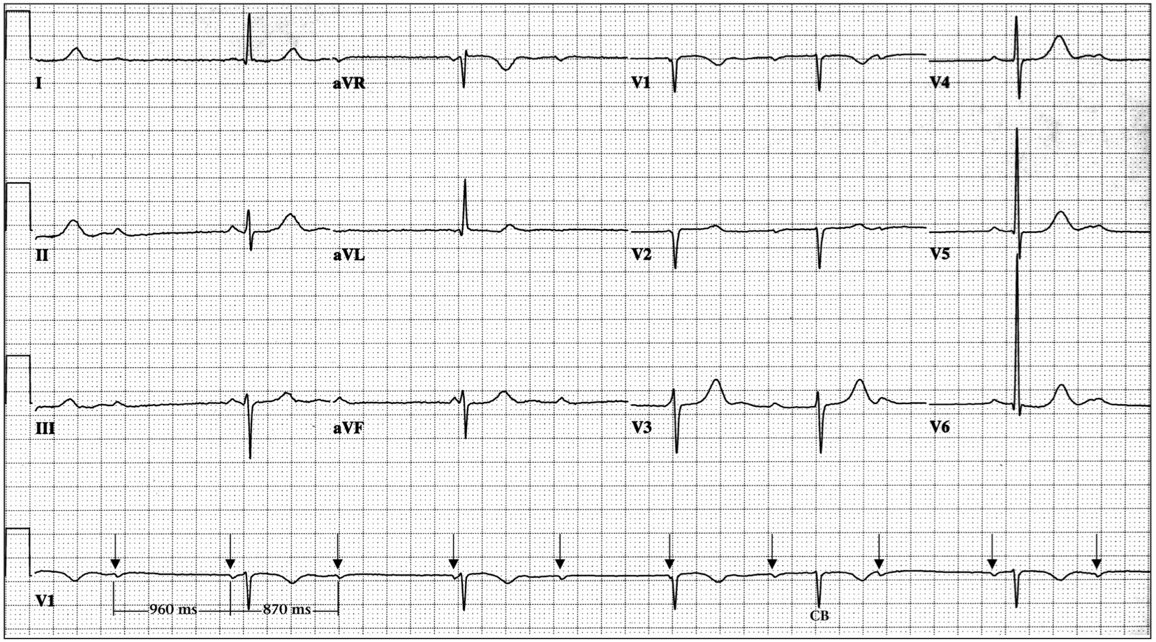 心室相性洞不整脈(ventriculophasic sinus arrhythmia)