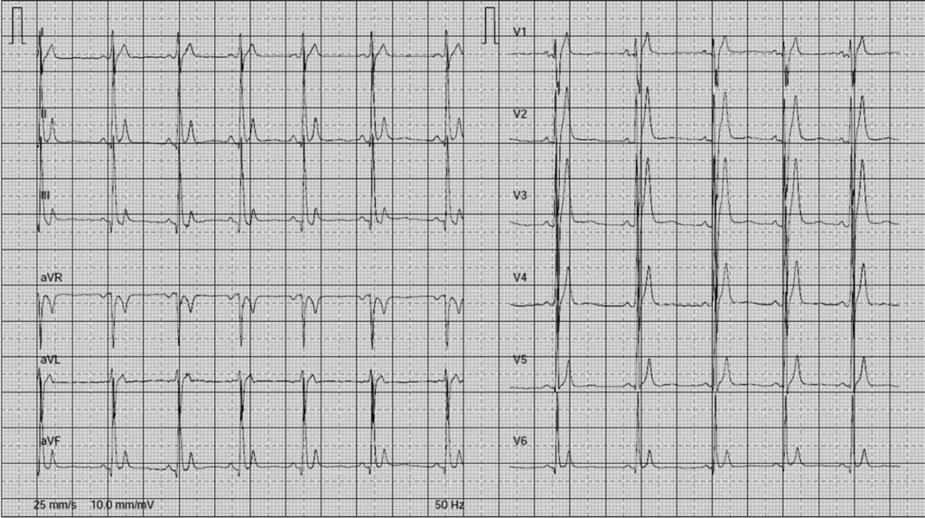 QT短縮症候群(short QT syndrome)