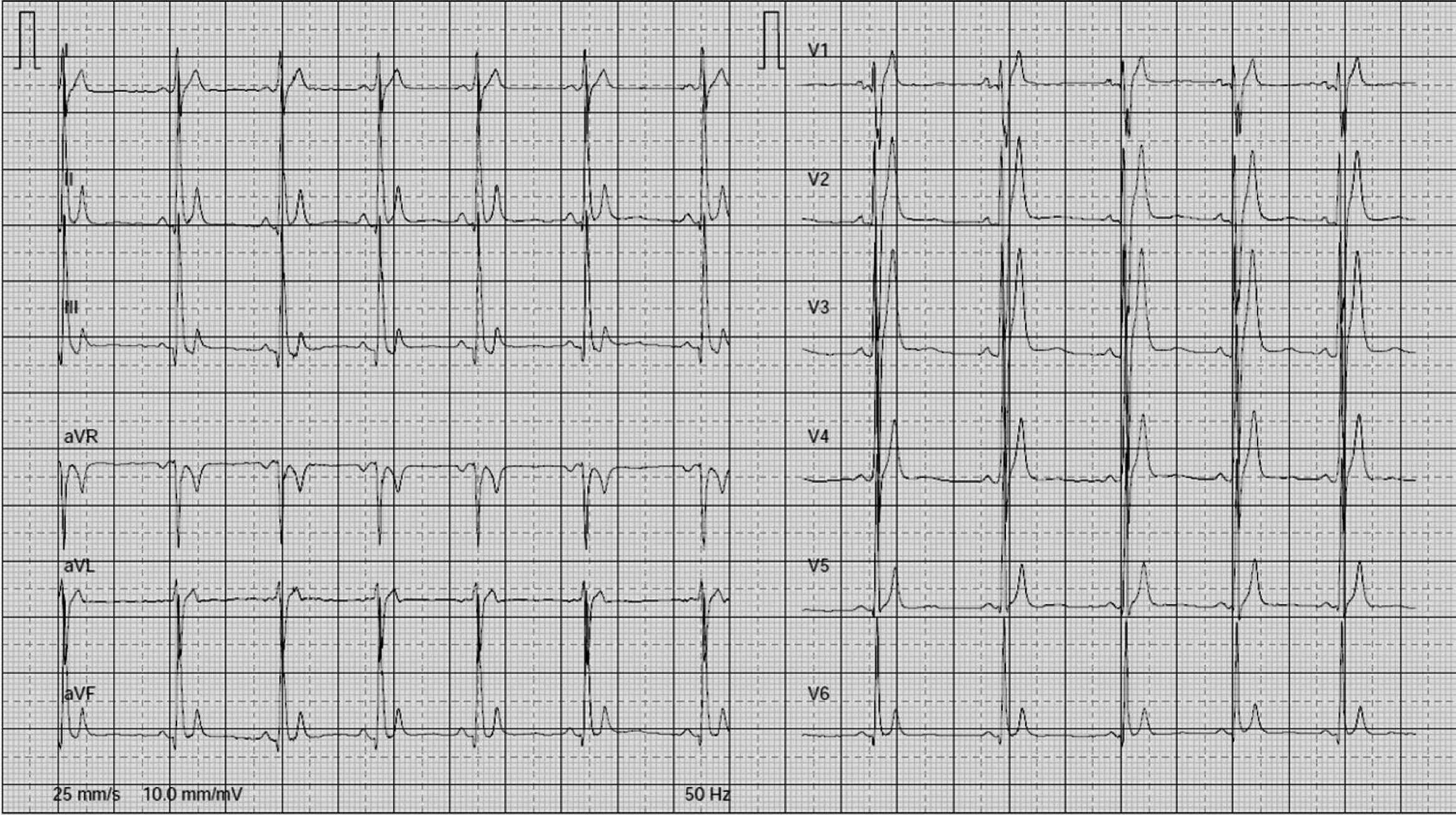 QT短縮症候群(short QT syndrome)