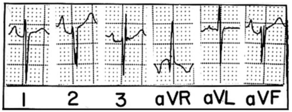 房室中隔欠損症(atrioventricular septal defect)