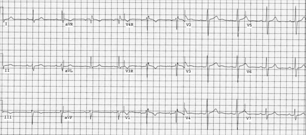 房室中隔欠損症(atrioventricular septal defect)