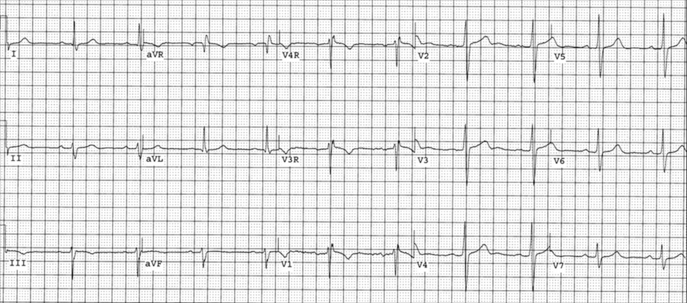 房室中隔欠損症(atrioventricular septal defect)