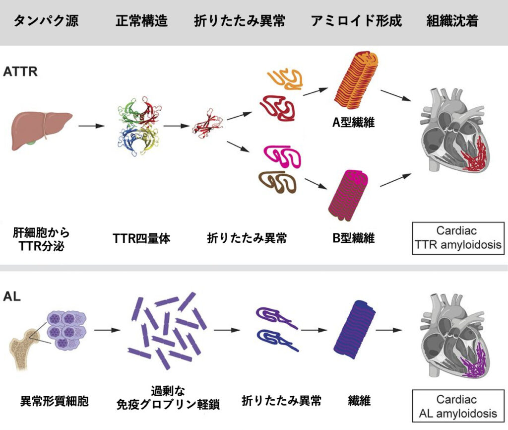 心アミロイドーシス(cardiac amyloidosis)