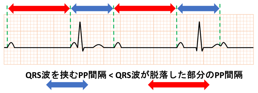 心室相性洞不整脈(ventriculophasic sinus arrhythmia)