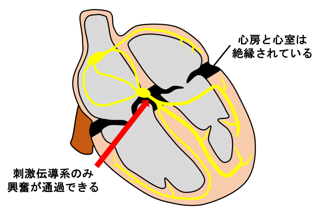 WPW症候群(Wolff-Parkinson-White syndrome)