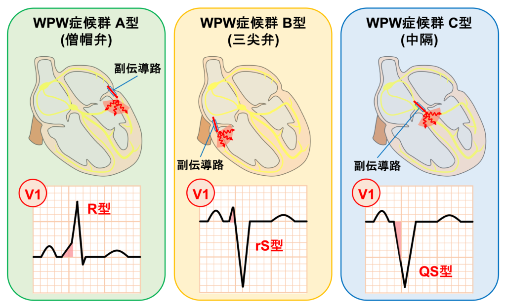 WPW症候群(Wolff-Parkinson-White syndrome)