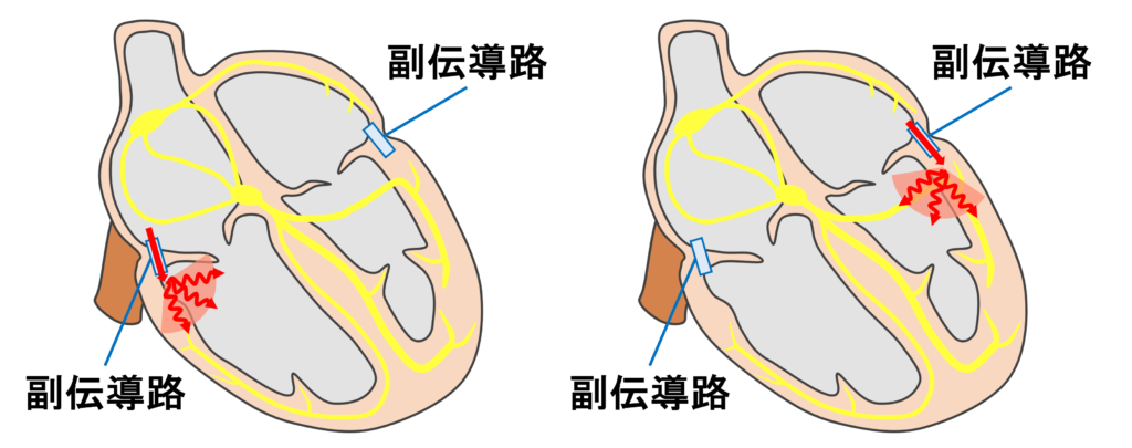 複数副伝導路(Multiple accessory pathway)