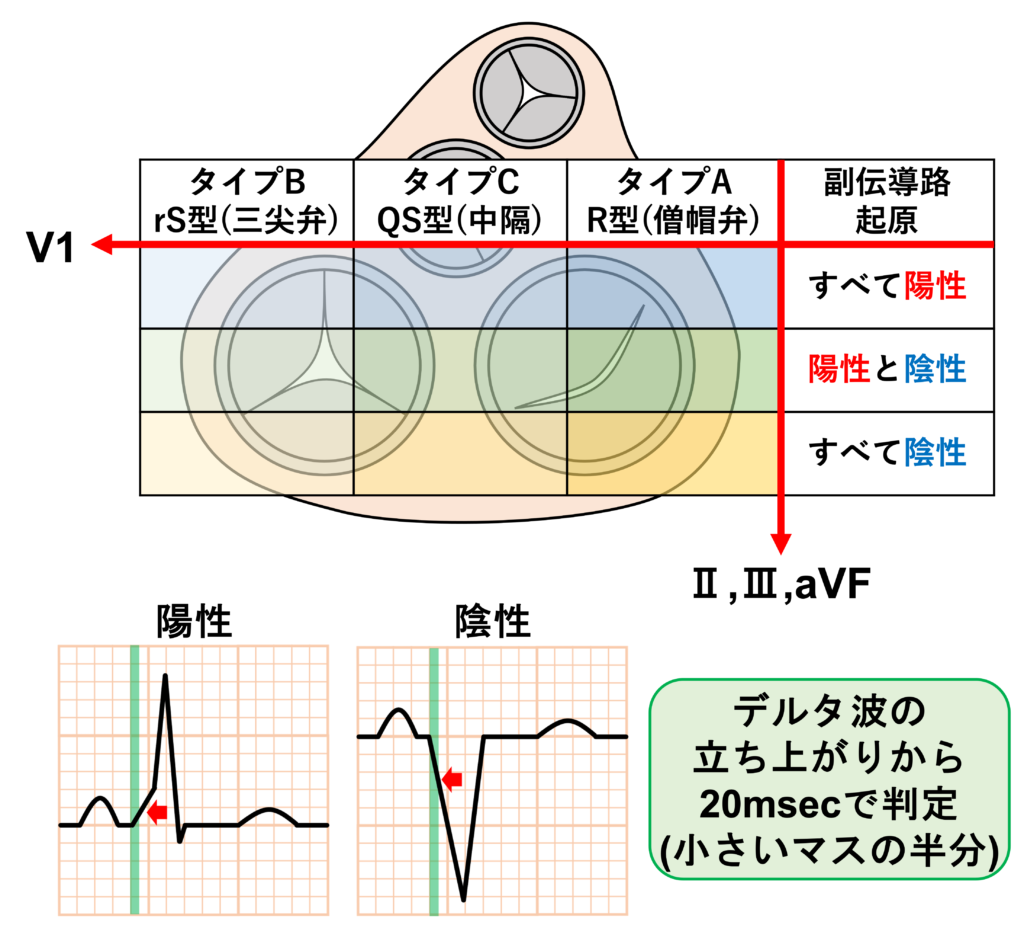 WPW症候群(Wolff-Parkinson-White syndrome)