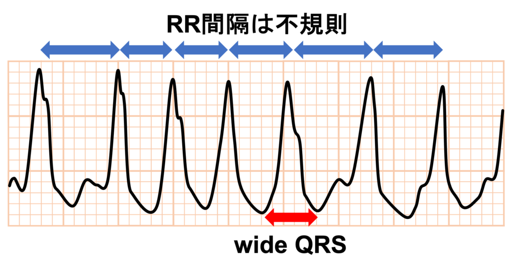 偽性心室頻拍(pseudo ventricular tachycardia)