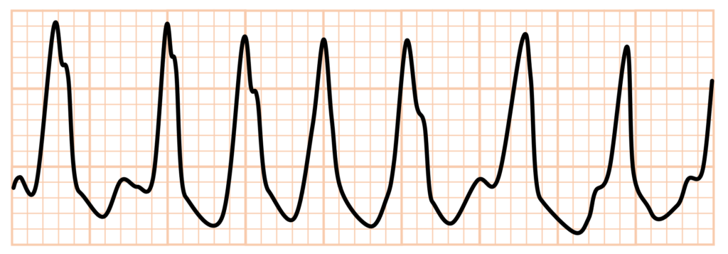 偽性心室頻拍(pseudo ventricular tachycardia)