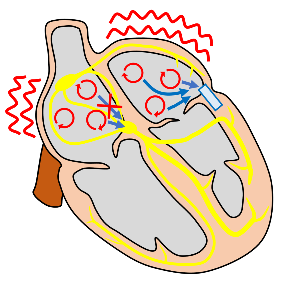 偽性心室頻拍(pseudo ventricular tachycardia)