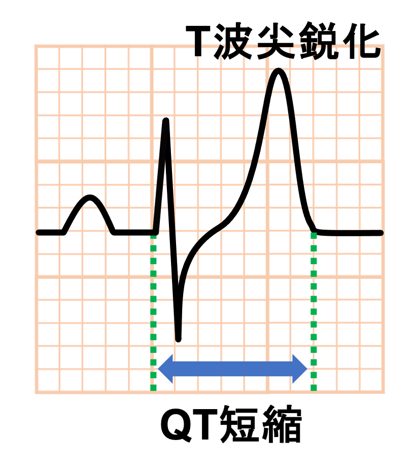 QT短縮症候群(short QT syndrome)