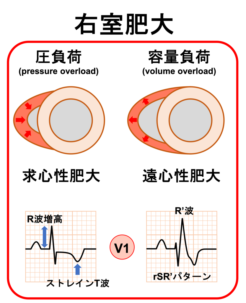 右室肥大(right ventricular hypertrophy)