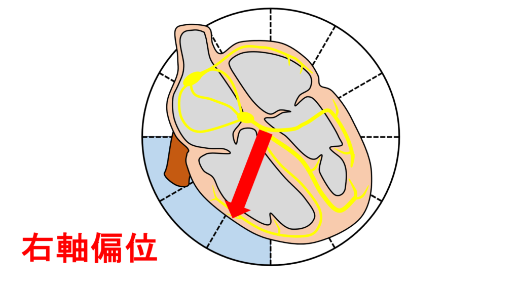 右軸偏位(right axis deviation)