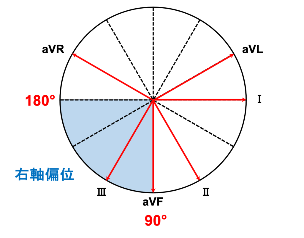 右軸偏位(right axis deviation)