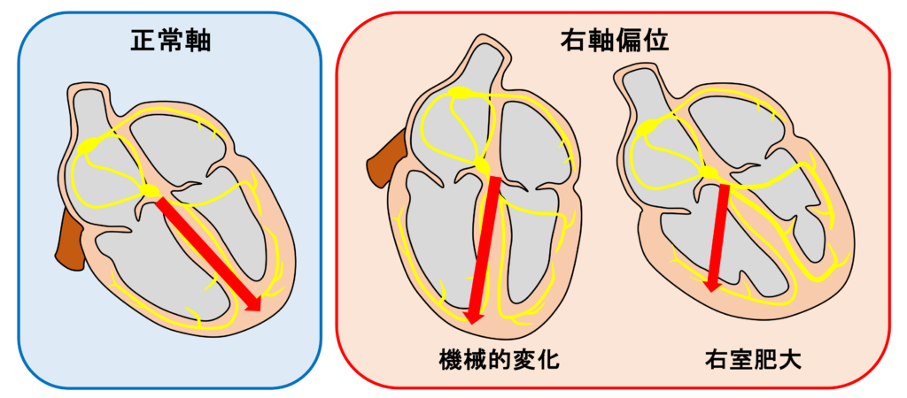 右軸偏位(right axis deviation)