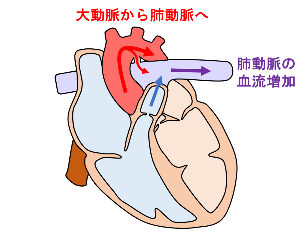 動脈管開存症(patent ductus ateriosus)