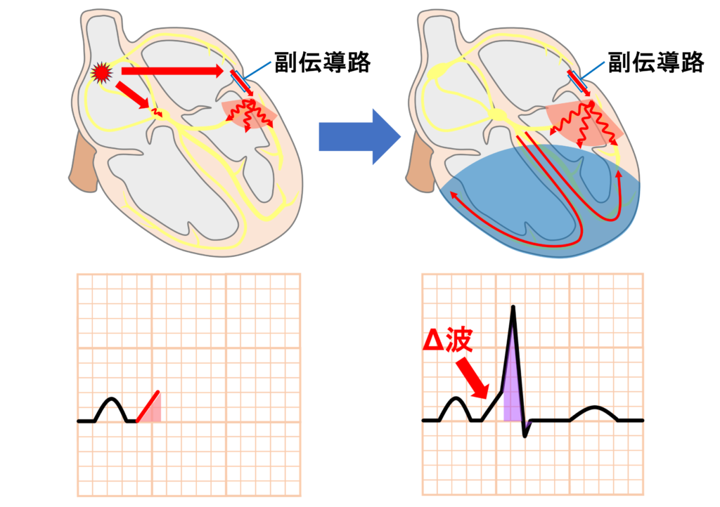 Δ波(delta wave)