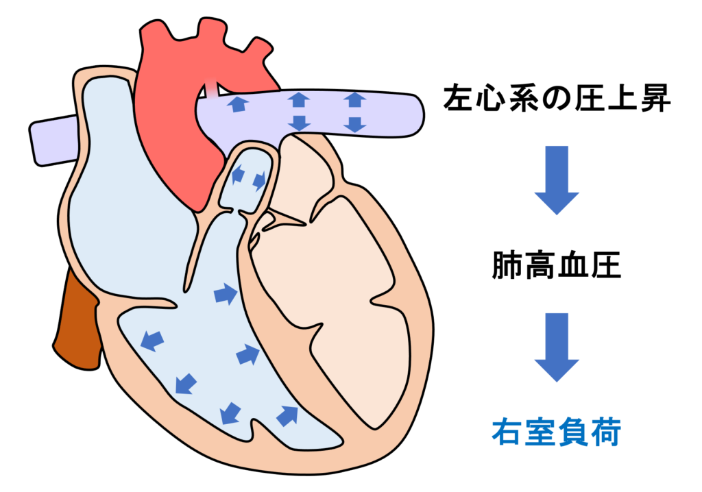 動脈管開存症(patent ductus ateriosus)