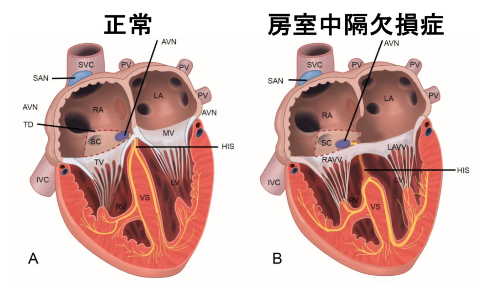 房室中隔欠損症(atrioventricular septal defect)