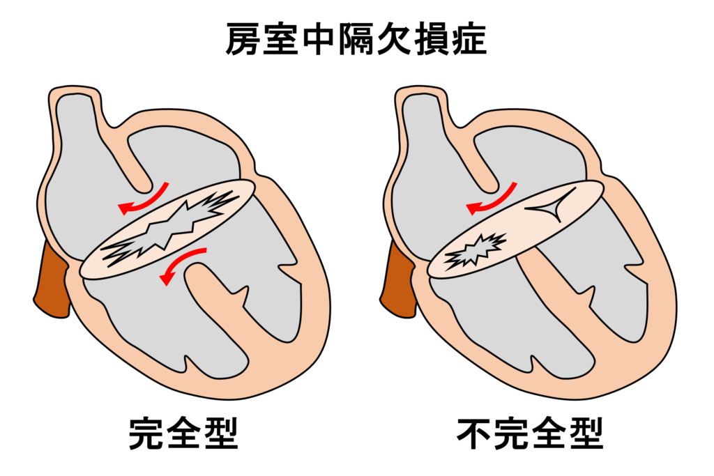 房室中隔欠損症(atrioventricular septal defect)